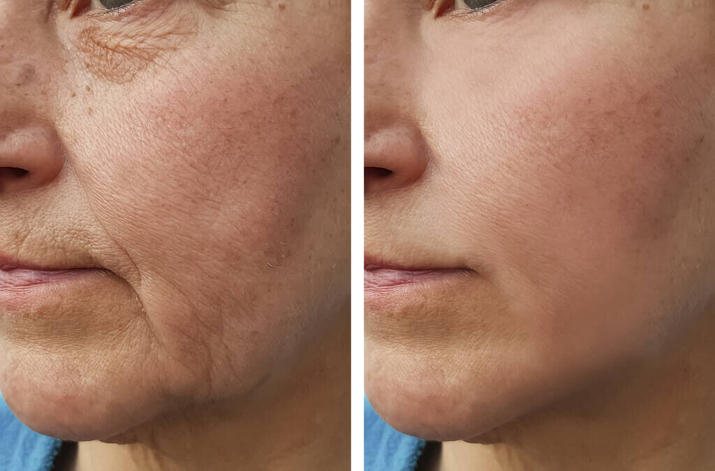 Why Weight Loss Can Age Your Face — And How to Fix It