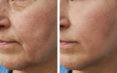 Why Weight Loss Can Age Your Face — And How to Fix It