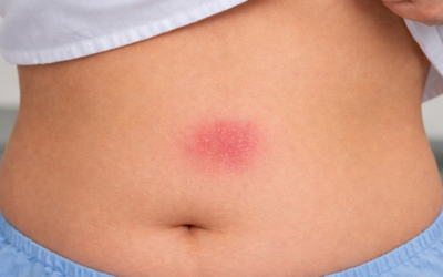 Redness or Itching From GLP-1 Injections? Here’s Why