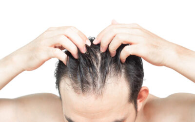 How to Keep Your Hair While Losing Weight